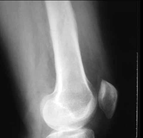 Subakut osteomiyelit 213 Şekil 4. Osteid osteoma benzeri radyolojik bulgu.