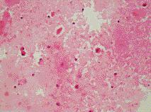 BAL ve bronfl lavaj patolojik tetkikinde zeminde ve alveoler makrofajlar