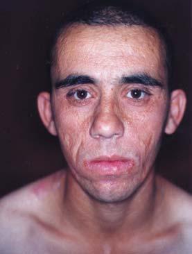 2004; 38: (1) TÜRKDERM Deri muayenesinde; yüz, göz kapaklar, diz ve dirseklerde küçük sar ya benzer, çok say da, 1-3 mm boyutlar nda papüler lezyonlar ile yer yer akneiform sikatrisyel alanlar