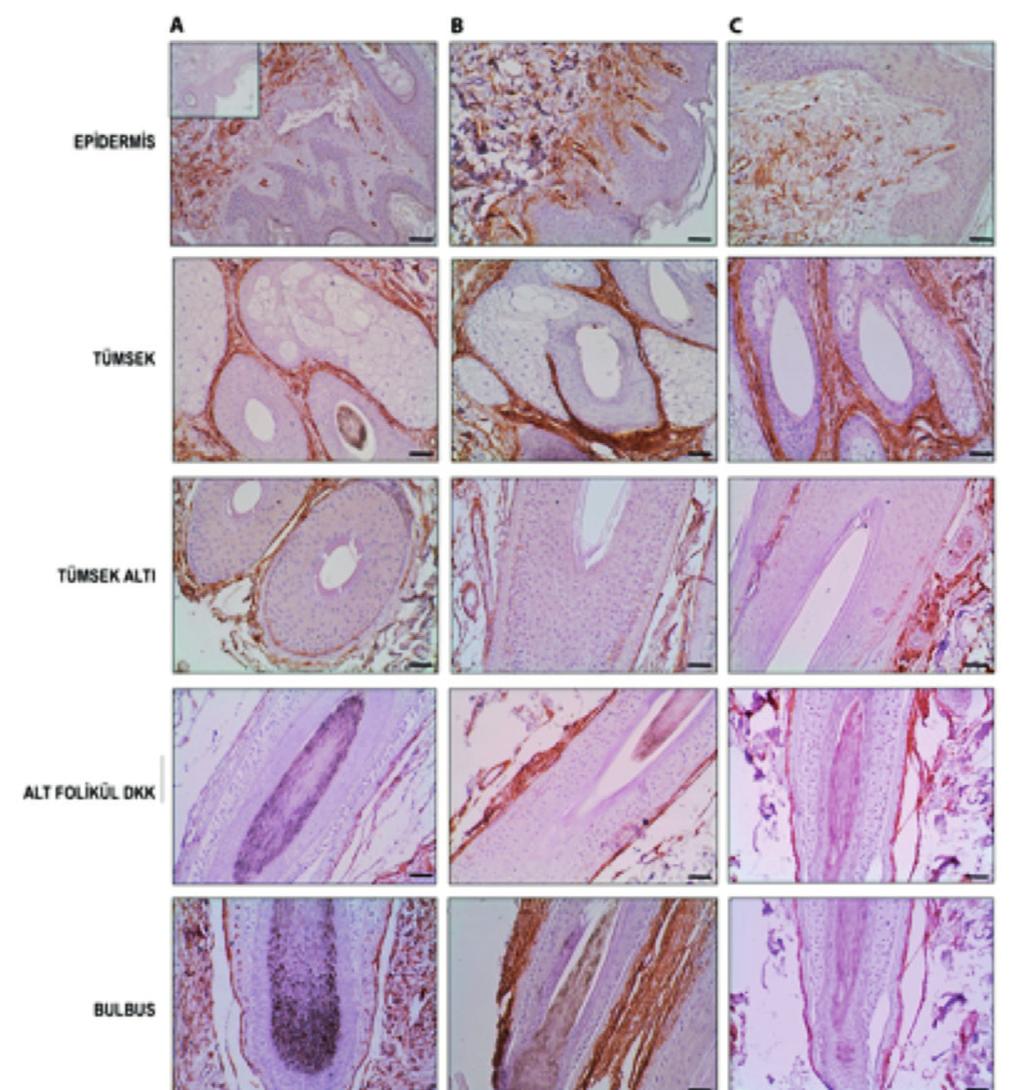 72 Dicle ve ark. Liken Planoplaris ve Kök Hücre elirteçleri. Turk J Dermatol 2017;11:704 kontroller ve hasta örneklerinde benzerdi (Tablo 2, Şekil 2).