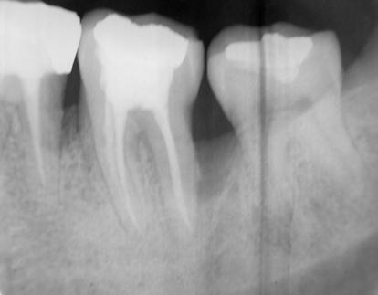 Örnek alınma işleminden sonra dişlerin endodontal ve periodontal tedavilerine uygun görülen tedavi prosedürlerine göre devam edildi.