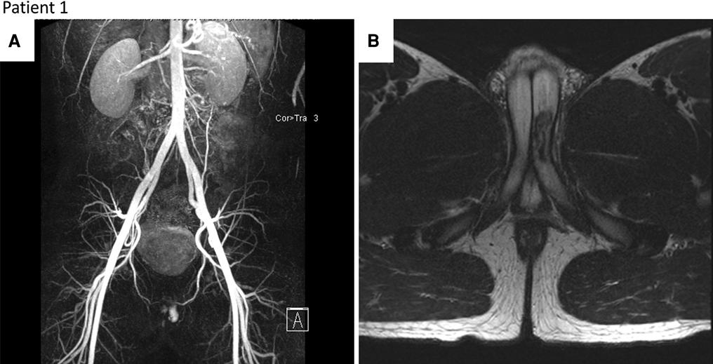 NIP MRI N: 4 Yüksek akımlı priapizm