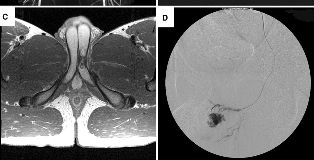 Embolizasyon öncesi Gadolinium MR