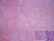 C, Ne op las - tic cells ex pan ding the mar gi nal zo ne and in fil tra ting the red pulp (H&E, x40). FI GU RE 3: T-cell-rich B-cell lympho ma in fil tra ting the sple en.