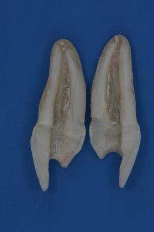 Resim 3 153 : Bukkolingual yönde longitudinal olarak ikiye ayrılan kök görüntüsü 2.7.2.Radyografi Kalan dolgu maddesinin değerlendirilmesinde kullanılan yöntemlerden bir diğeri radyografik incelemedir.