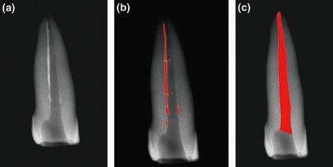 Resim 4 40 : Kök kanalında kalan dolgu artıklarının radyografik olarak incelenmesi 2.7.3.