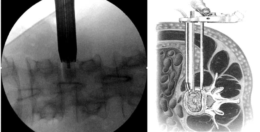 Şekil-7. XLIF Ekstreme lateral interbody füzyon. SONUÇ : Dekompresyon sonrası lomber omurganın tekrar stabiltesinin sağlanmasında yukarıda bahsedildigi gibi çok farklı füzyon yöntemleri mevcuttur.