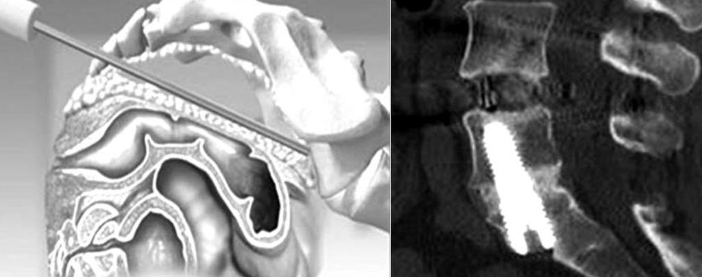 Şekil-4. Trans-aksiyal lomber interbody füzyon. Şekil-5. Transforaminal lomber interbody füzyon.