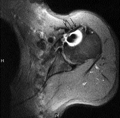 tendon bütünlü ünün korundu u görüldü (fiekil 2, 3). Tart flma Subskapularis tendon y rt klar s k görülmemesine karfl n nadir de ildir.