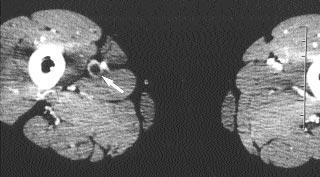 A B C Resim 3. A. ndirekt BTV'de sa yüzeyel femoral vende genifllemeye yol açm fl akut tam trombozis (ok) dikkati çekiyor. B. Renkli Doppler US'de yüzeyel femoral arterin (SFA) alt nda genifllemifl ve lümeni hipoekoik trombüsle dolu, ak m örne i içermeyen yüzeyel femoral ven (SFV) izleniyor.