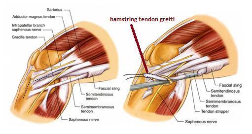 K-Pt-K greftinin kısa dönem morbiditesinin hamstring tendon greftine göre daha yüksek olması, bu greftin günümüzde rekonstrüksiyon endikasyonu olan her hastada ilk seçenek olması gerekliliğini