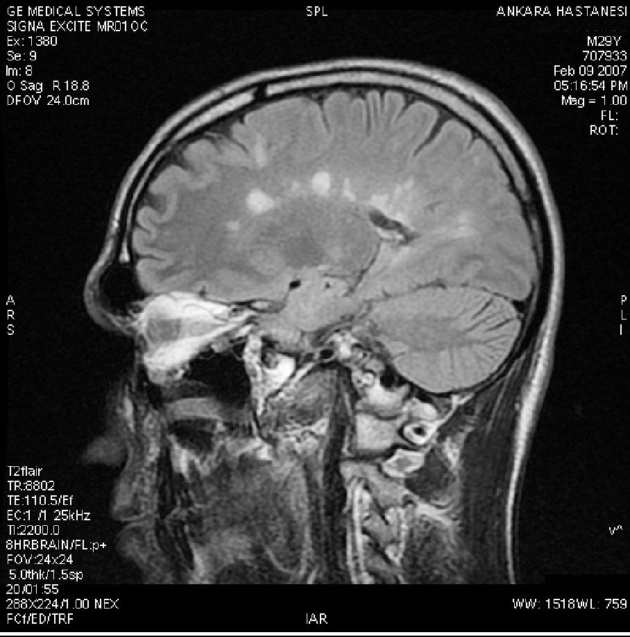 Kranyal MR: T2 ve FLAIR sekanslarda corpus kallozum, beyin sap ve üst servikal spinal kordda periferal opaklaflma gösteren (akut süreçte demiyelinize plak) yayg n demiyelinize plak yap lar gözlendi.