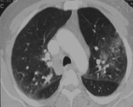 Sağda anterior trunkusta emboli saptanan hastada sağ akciğer üst lob posterior segmentte hava bronkogramları içeren konsolide alan izlenmekte.