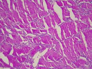 Toraks bilgisayarlı tomografisinde (resim 2); paratrakeal, prekarinal ve aortikopulmoner 1 cm büyüklüğünde lenf nodları, her iki akciğer parankim alanlarında orta ve alt loblarda daha belirgin