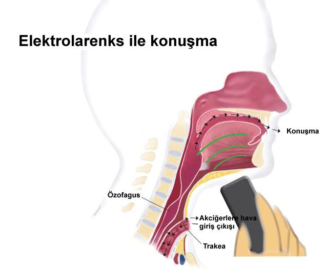 Larenjektomi Rehberi Dr. Itzhak Brook Şekil 4.