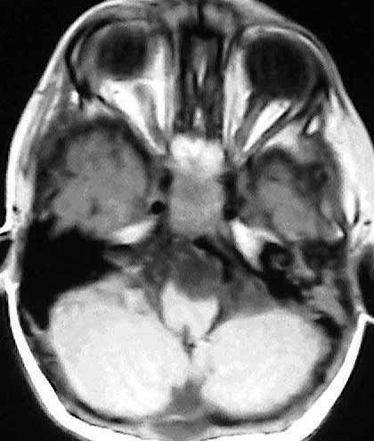 2A 2B Şekil 2A ve 2B: Postoperatif 1.