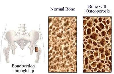 gözeli kemik = porous bone Osteoporoz: Düşük kemik