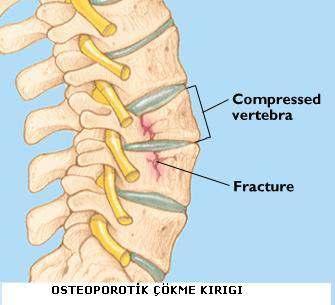 Kompresyona Uğramış vertebra Kırık Osteoporotik kırıklar En sık T