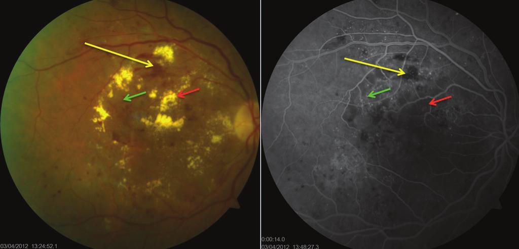 Ret-Vit Özel Sayı 2014;22:51-56 Öztürk 53 a b Resim 1a, b:diabetik maküler ödemli bir olgunun fundus fotoğrafı (a) ve FFA Bulgularının (b) karşılaştırması.