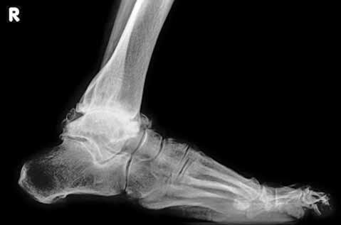 zorlaştıran ayak arkası veya distal tibiada ciddi açısal deformite varlığıdır. [1-3,9-12,14] Açısal deformitelerde implantın uygulanabilmesi için distal tibiaya osteotomiler gerekebilir.