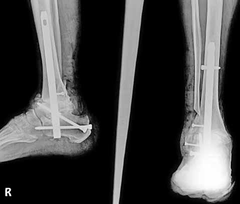 tespite izin veren distal kilit özelliği olan ayak arkası çivisi artrodezi uyguladık. Hastaların tümünde (3 kadın, 1 erkek; ort.