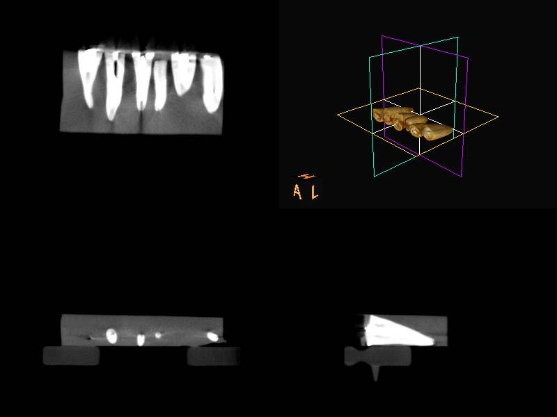 51 Şekil 3.15. Kodak konik ışınlı bilgisayarlı tomografi görüntüleme ve planlama yazılım sisteminde görüntülerin üç boyutlu olarak değerlendirilmesinin temsili görüntüsü.