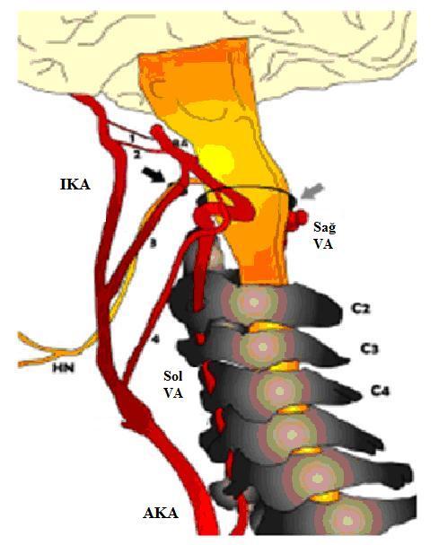 İkinci en sık karotid vertebral anastomoz primitif hipoglossal arter (PHA) dır. Bu anormal damar hipoglossal kanaldan 7.
