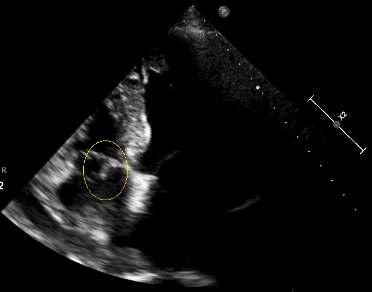 TTE Triküspime septal yaprakçıkla ilişkili 13 mm