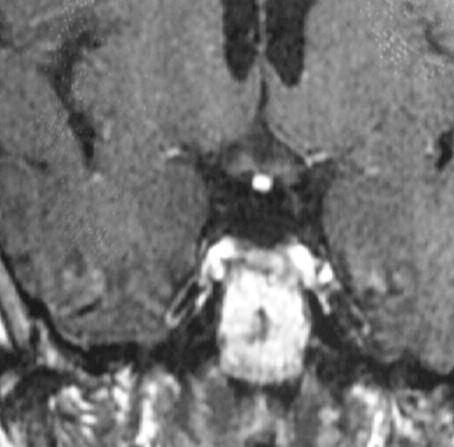 Endocrinology and Metabolic Diseases Kılıç Kan et al. veya hipofiz yetmezliği sebeplerinden olan PSIS tanısı için bu grup hastaların dikkatli değerlendirilmesi gerekir.