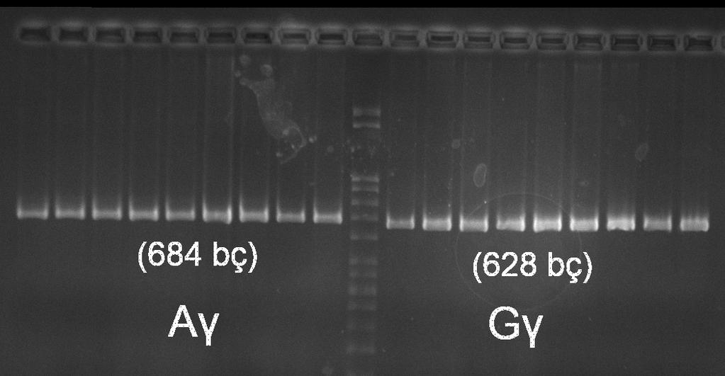 4. BULGULAR Bu çalışmada HbF düzeyi % 1.5 ve daha yüksek olan toplam 62 kişinin hem G γ ve hem de A γ genlerinde (HBG2 ve HBG1) delesyonel ve non delesyonel mutasyonlar taranmıştır. 4.1. Non Delesyonel Mutasyonların Taranması Non delesyonel mutasyonların taranması için her iki genin promotör dizilerinin sekansları saptanmıştır.