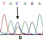 A γ geninde +25 lokasyonlu varyasyonlar, a)+25 A/A homozigotlar, b)+25 A/G heterozigotları, c)+25 G/G homozigotları A γ geninin