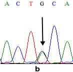 9a), 23 kişinin G/A heterozigot (Şekil 4.