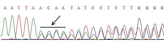 Ayrıca yine A γ geninde aynı mutasyon (-222 ile -225 bölgelerinde AGCA delesyonu ) toplam 6 kişide heterozigot halde oluşmuş ve bu noktadan sonra çerçeve kayması mutasyonunun varlığı saptanmıştır