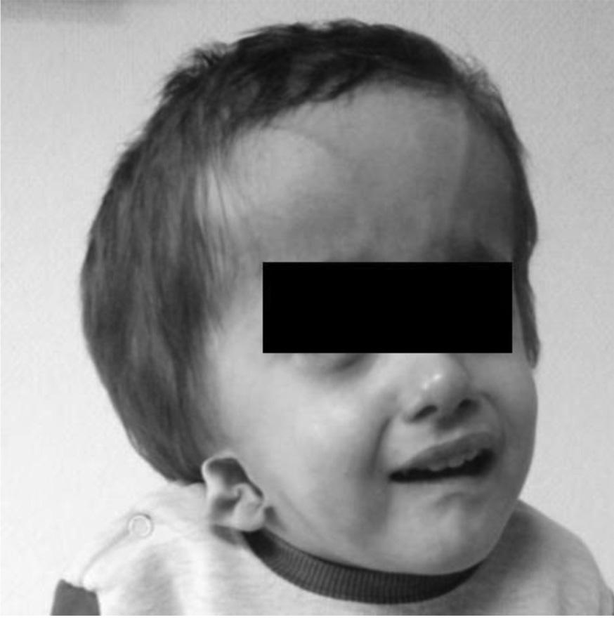 İki yaşında düşük yerleşimli ve deforme görünümlü heliks, ağlarken fasiyel