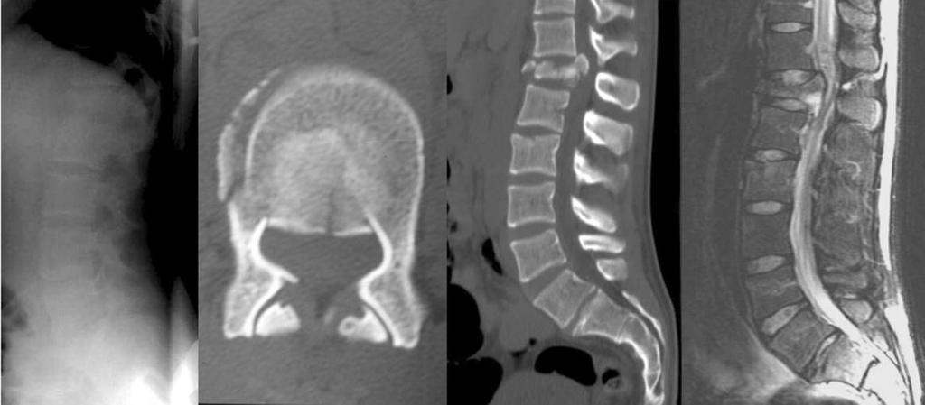 Nörolojik defisit olan hastalarda, spinal kanal ve omuriliğin değerlendirilmesi için MR görüntülemeye başvurulabilir.