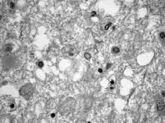 TARTIÞMA Menenjit terimi, leptomeninkslerin ve subaraknoidal mesafenin inflamasyonunu tanýmlamaktadýr.