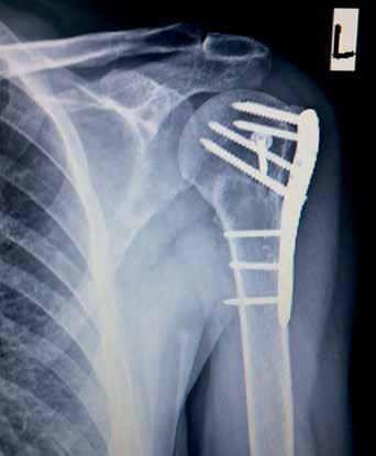 deplsmnını, 24 stten fzl humerus şının çıkık olmsını, dh önce rottor mnşet yırtığı tnısı olmsını ve meliyt sırsınd çık redüksyon ve internl fikssyondki şrısızlığı göstermişlerdir.