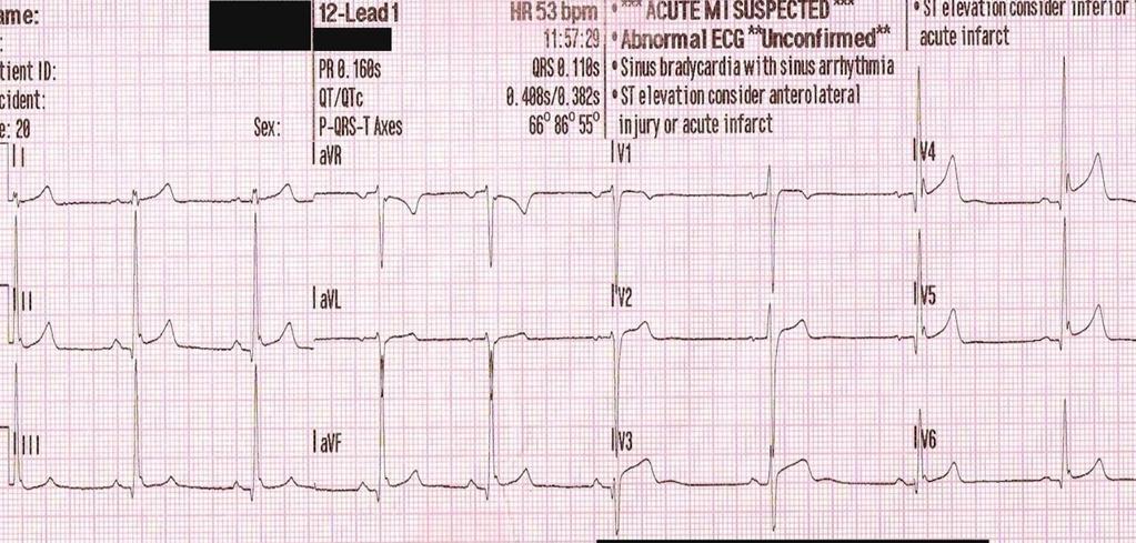 STEMI mi yoksa benign