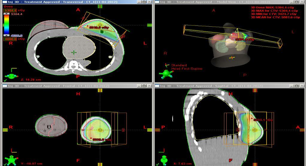 33 2.2.4. Tedavi Planlaması BT kesitleri alınan fantomun hedef hacim ile OAR konturları radyasyon onkoloğu tarafından belirlendikten sonra radyoterapi planlamalarına geçildi. 2.2.4.1.