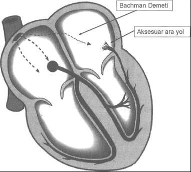 8 1.2 GENİŞ QRS'Lİ TAŞİKARDİLER 1.2.1 SVT'lerde Geniş QRS'e Neden Olan Durumlar Bazı istisnai durumlarda ritim bozukluğunun kaynağı supraventriküler olmasına rağmen, ORS'ler 0,10 saniyenin üzerinde yani geniş görülür.