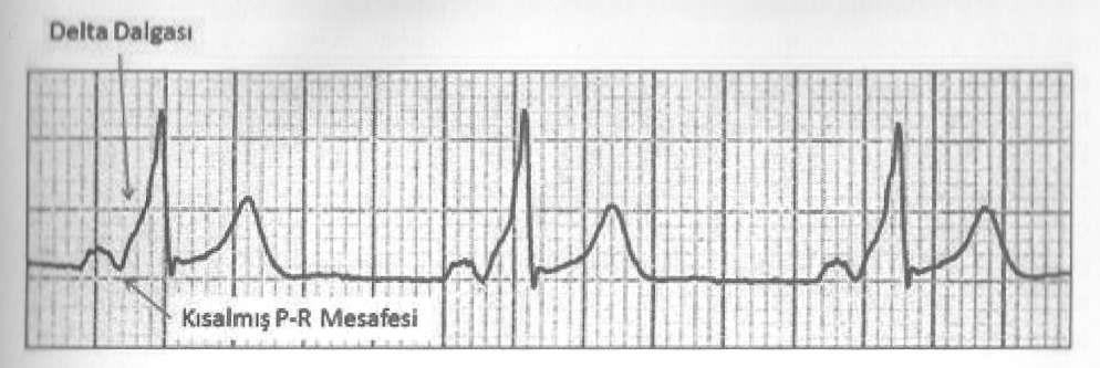 9 WPW'de EKG Özellikleri; 1.2.1.1.1 WPW'de EKG Özellikleri PR aralığı 0.12 saniyeden daha kısadır. Çünkü ileti, normal yol dışında, daha kısa bir yoldan da iletilmektedir.