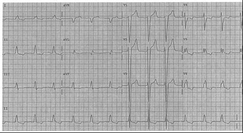 16 Resim 20: Sol dal bloğu; V5 ve V6'da çentikli R dalgaları dalgaları görülmekte Sol dal bloğu başlıca nedenleri; Organik kalp hastalığı, Koroner arter hastalığı, Hipertansiyon, Aort stenozu