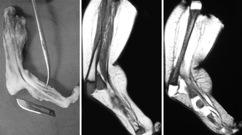 88 Eklem Hastal klar ve Cerrahisi - Joint Dis Rel Surg (a) (b) (c) T F fiekil 3. (a) Cilt ve ciltalt doku eksize edildikten sonra ampute baca n görüntüsü. Kas tendon ünitelerinin bir k sm görülüyor.
