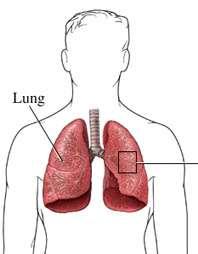 Akciğer Ödemi Ekstravasküler akciğer sıvısındaki
