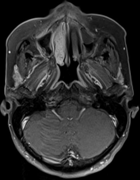 Bu aralık içinde parotis bezi ve styloidprosesvardır ve arkada birinci servikal vertebranıntransversprosesi ve lateraldesternokleidomastoid kas ile sınırlıdır.