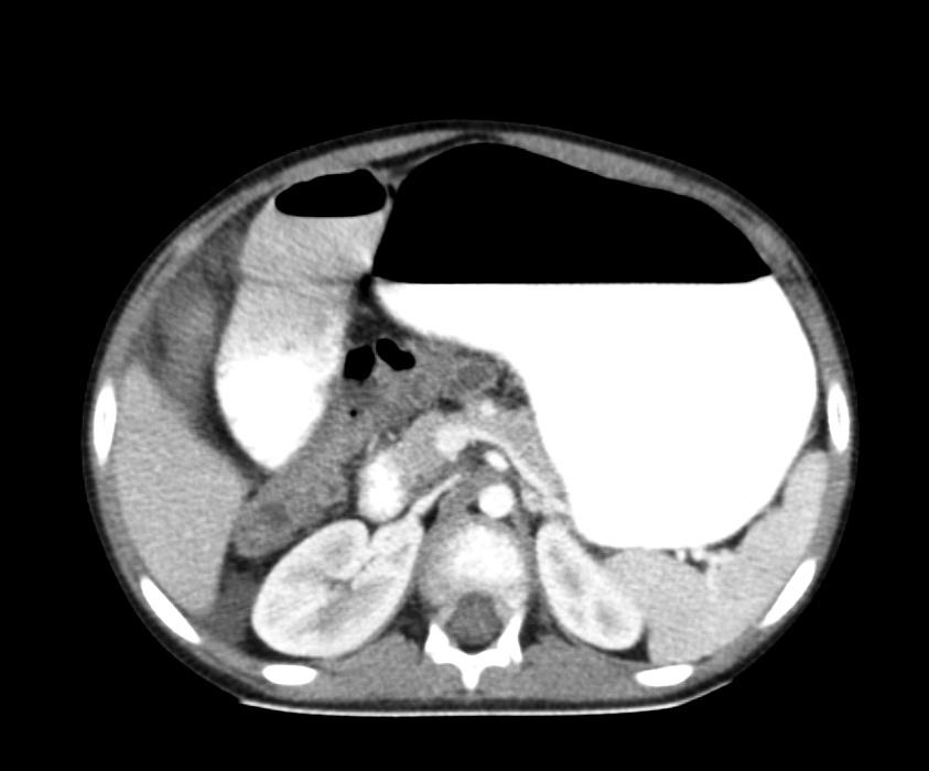 Yutulan maddelerin çoğunluğu, hiçbir soruna neden olmadan gastrointestinal sistemden kendiliğinden atılırken, %10 ile 20 sinde endoskopi ile çıkarılması gerekmektedir (1).