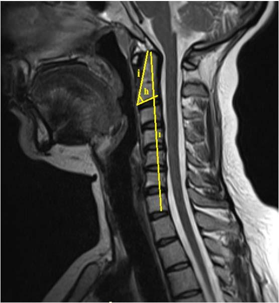 e- Medulla spinalis in sagittal çapı, f- Canalis vertebralis in sagittal çapı, g- Spatium retropharyngeum aralığı) Şekil 3.2.