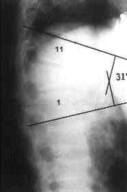 Çelebi ve ark. Torakolomber vertebra burst k r klar nda konservatif tedavinin etkinli i 19 (rezidüel kifoz) ile Denis a r (r=0.08, p>0.05) ve ifl (r=-0.59, p>0.