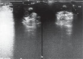 Hastanýn ameliyatýnda lateral retinaküler gevþetme ile beraber patellar tendonun ½ lateral parçasý medialize (Roux-Goldwhait) edilmiþ ve medialdeki kapsül vastus medialis ile beraber daraltýlmýþtýr.