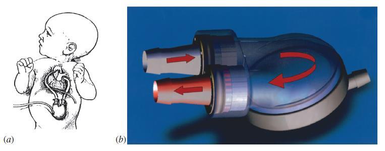 (a) Pennsylvania Eyalet Üniversitesi tarafından geliştirilen 12 cc lik pediyatrik ventrikül destek cihazının (PVAD) bir ressam